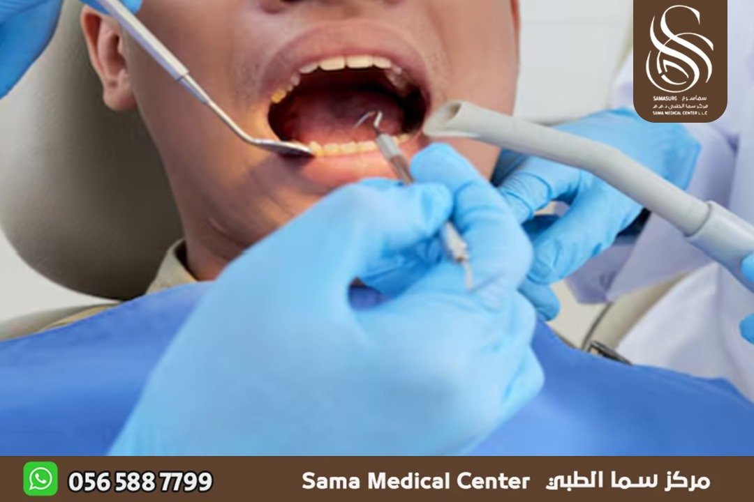 علاج عصب الاسنان في الشارقة