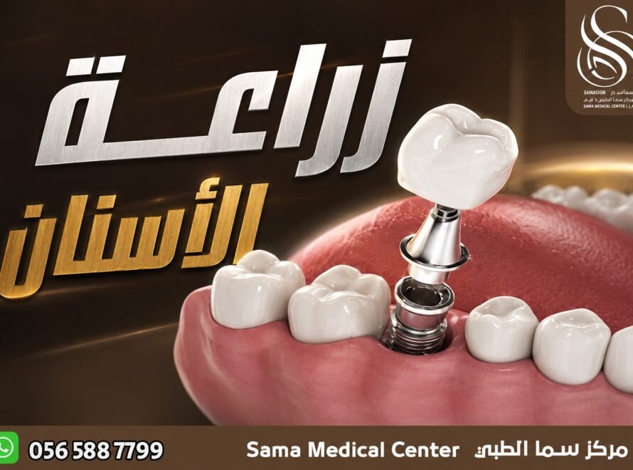 زراعة أسنان في الشارقة