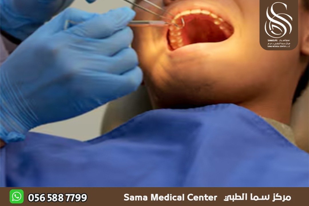 علاج عصب الاسنان في الشارقة