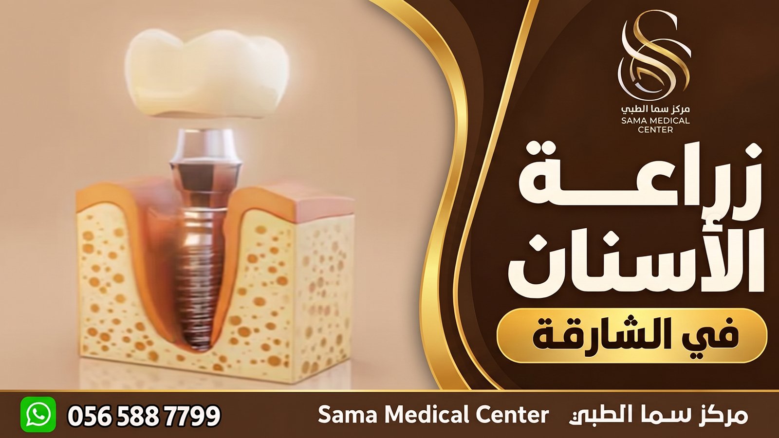 زراعة الأسنان في الشارقة